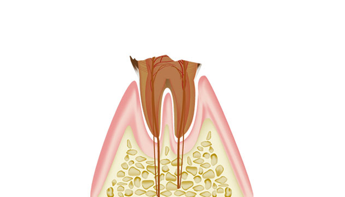 マイクロスコープを用いた虫歯治療