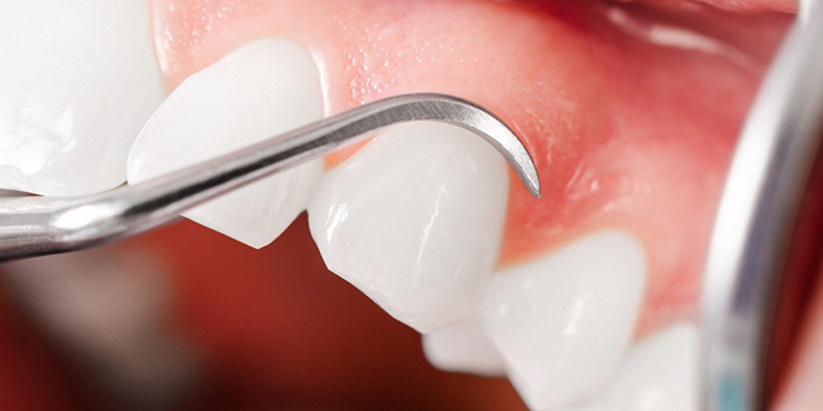 当院の歯周病治療の特徴について