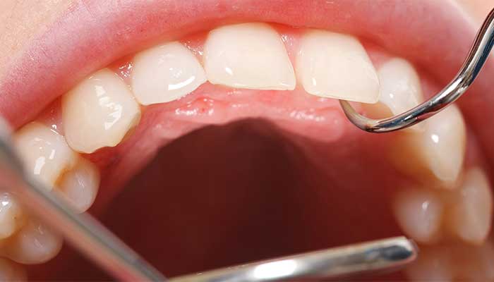 歯周外科（重度歯周病治療）